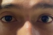 Mata Tampak Selalu Mengantuk? Kenali Ptosis dari Sisi Medis