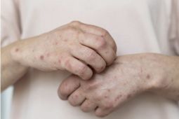 Satu Kasus Campak Terkait Perjalanan dari Indonesia Dilaporkan di Australia