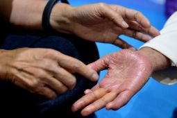 Kenali Macam-macam Penyakit Autoimun Sejak Dini