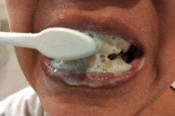 Kenali tanda gusi meradang yang sering dianggap sepele