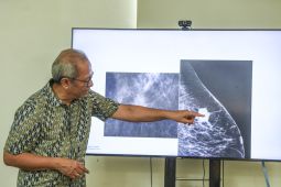 Waspadai! Ini ciri-ciri kanker payudara yang sering diabaikan wanita