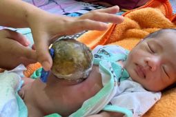 Bayi di Pandeglang Butuh Bantuan untuk Operasi Kelainan Usus