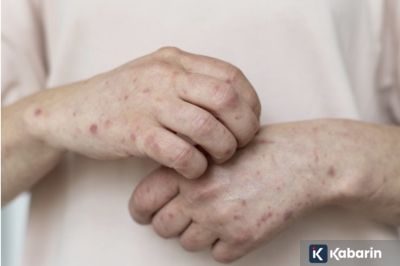 Satu Kasus Campak Terkait Perjalanan dari Indonesia Dilaporkan di Australia