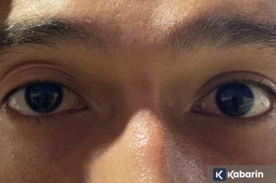Mata Tampak Selalu Mengantuk? Kenali Ptosis dari Sisi Medis