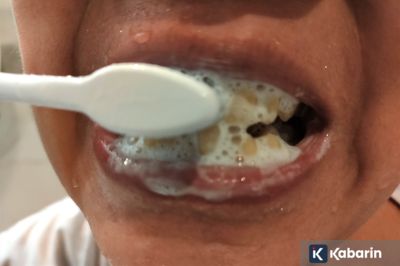 Kenali tanda gusi meradang yang sering dianggap sepele