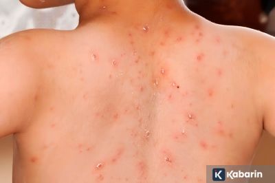 Tiga Fase Gejala yang Harus Diwaspadai saat Terkena Campak