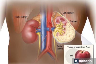 Memahami Kanker Ginjal, Penyakit yang Menyerang Vidi Aldiano
