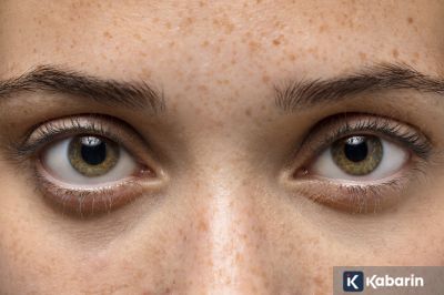 Mata Sering Kedutan Bisa Jadi Tanda Kamu Stres