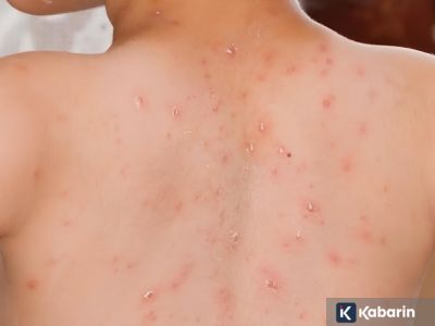 Vaksin selamatkan 59 juta nyawa, tapi campak kembali merebak di 59 negara