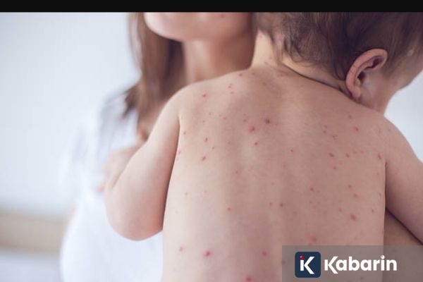 Masyarakat Diminta Waspadai Penularan Campak saat Lebaran