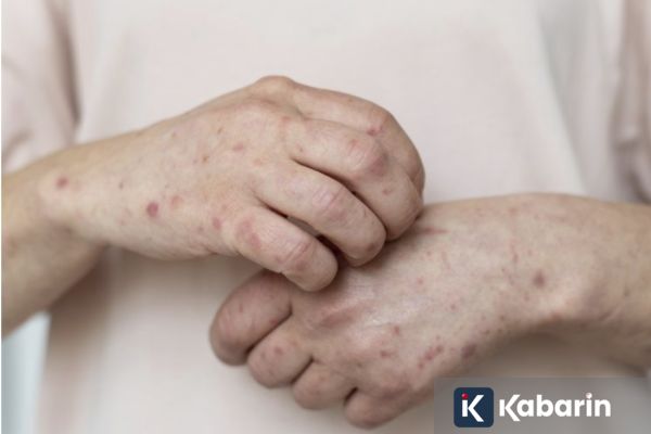 Satu Kasus Campak Terkait Perjalanan dari Indonesia Dilaporkan di Australia