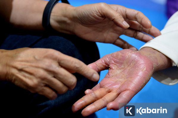 Punya Psoriasis? Hindari 3 Kebiasaan Sore Ini agar Tidur Nyenyak