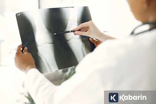 Pentingnya Jaga Kesehatan Tulang Sejak Muda untuk Cegah Osteoporosis