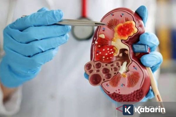 Dehidrasi hingga Hipertensi Bisa Jadi Faktor Penyebab Gagal Ginjal