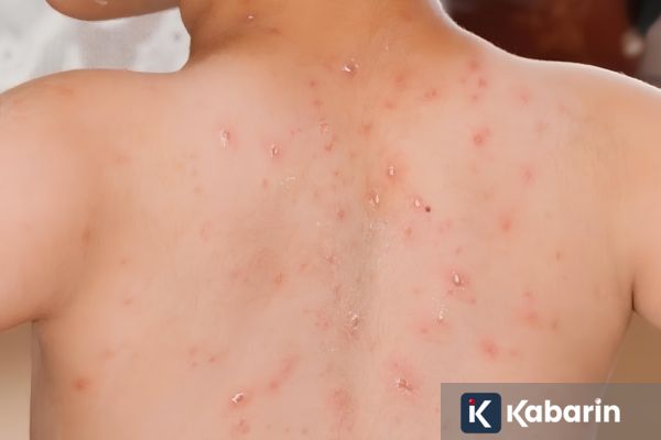 Vaksin selamatkan 59 juta nyawa, tapi campak kembali merebak di 59 negara