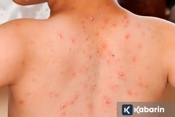 Tiga Fase Gejala yang Harus Diwaspadai saat Terkena Campak