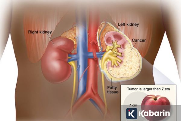 Dokter Ingatkan Pentingnya Cukup Minum Air Agar Ginjal Tetap Sehat Saat Puasa