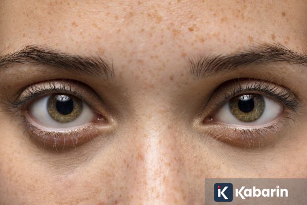 Mata Sering Kedutan Bisa Jadi Tanda Kamu Stres